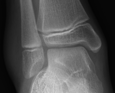 X-Ray of a severely sprained ankle.